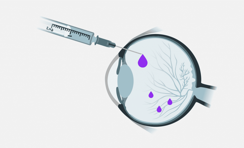 Vecuma-izraisita-makulas-degeneracijas-arstesana